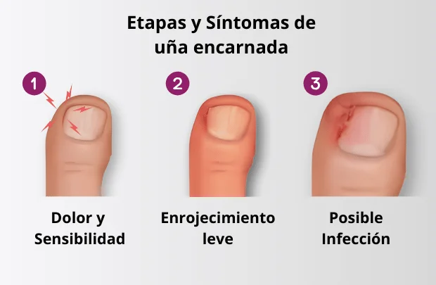 Etapas y síntomas de una uña encarnada o onicocriptosis