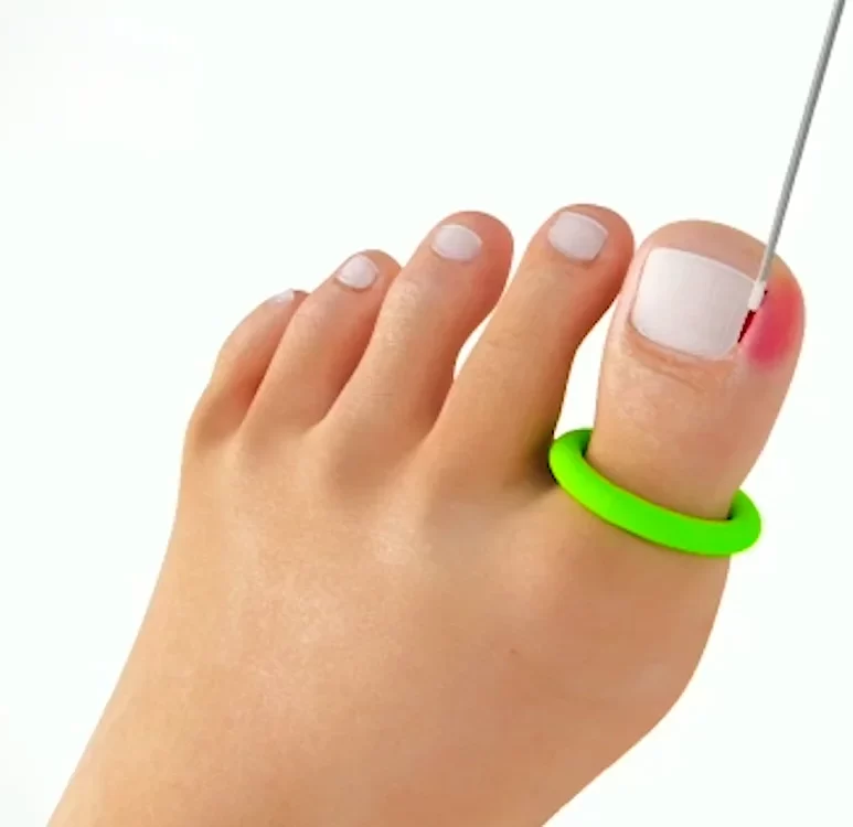 tratamiento para uñas encarnadas Azcapotzalco